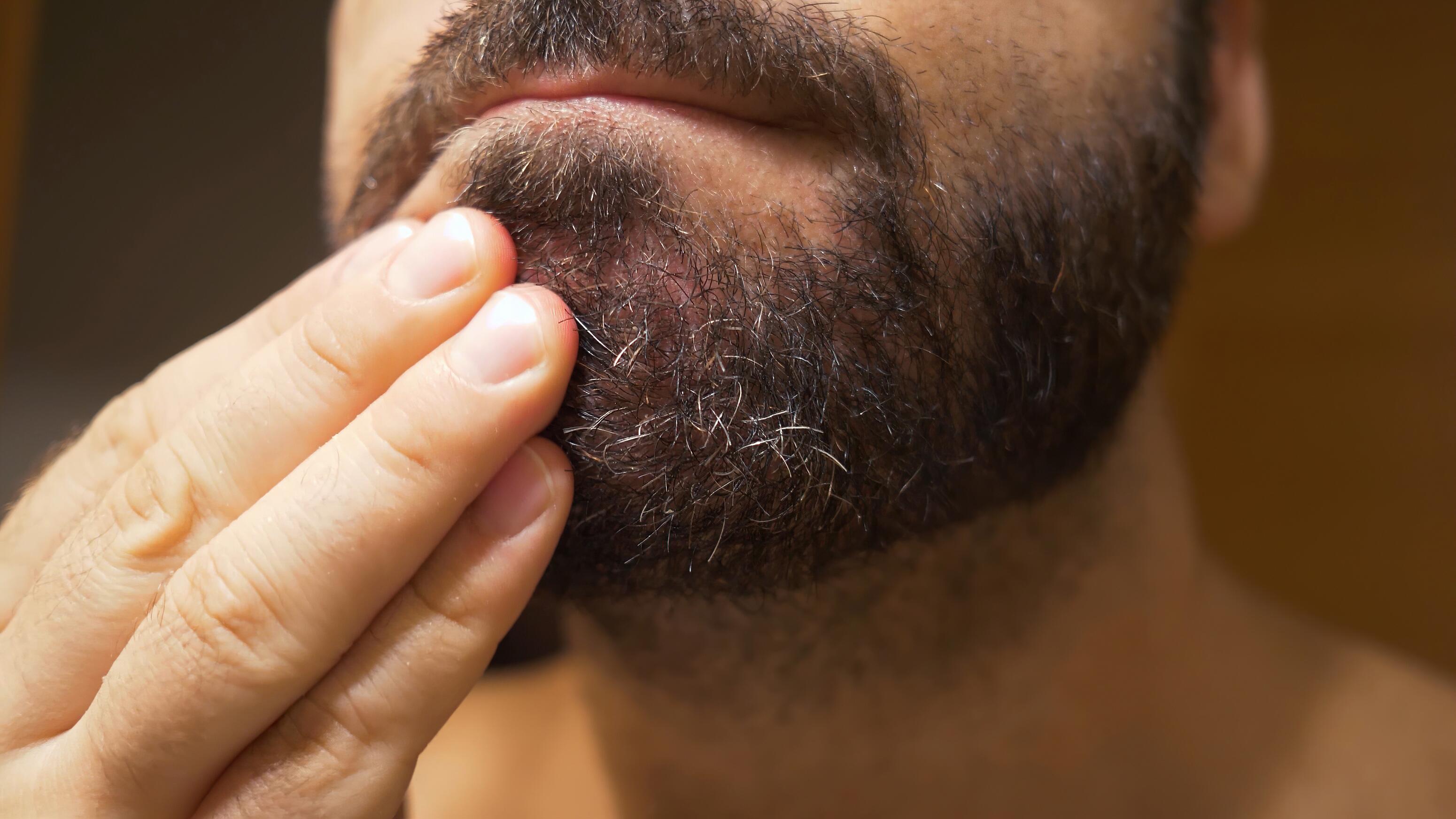 Dermite séborrhéique sous la barbe